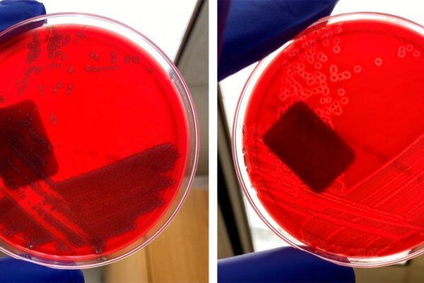 实验室诊断：大肠杆菌（腹泻）