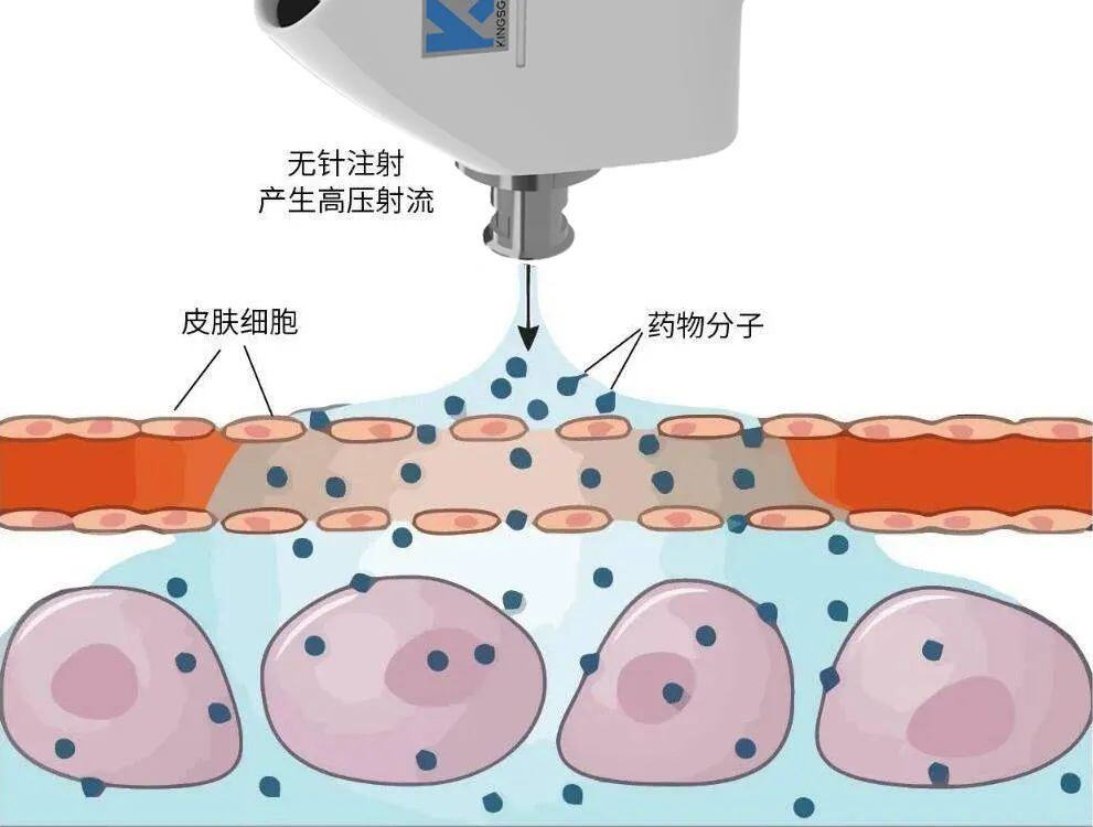 万头母猪场成本节约140余万元！金斯杰电动皮内无针注射器全新升级，精准免疫助力猪场真提效